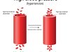 High blood pressure (Hypertension)