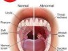 Throat Infection