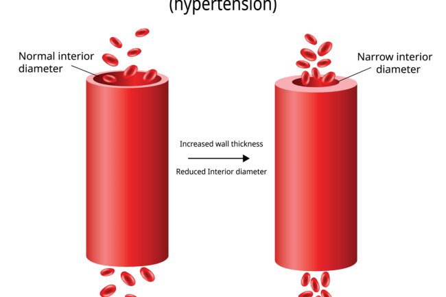 High blood pressure (Hypertension)