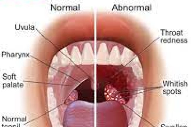 Throat Infection