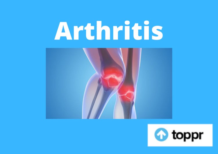 Arthritis