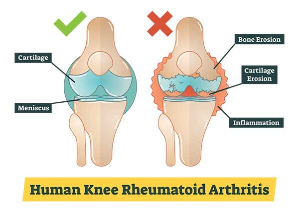 Arthritis